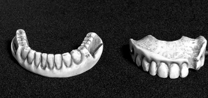 Dentadura postiza.png